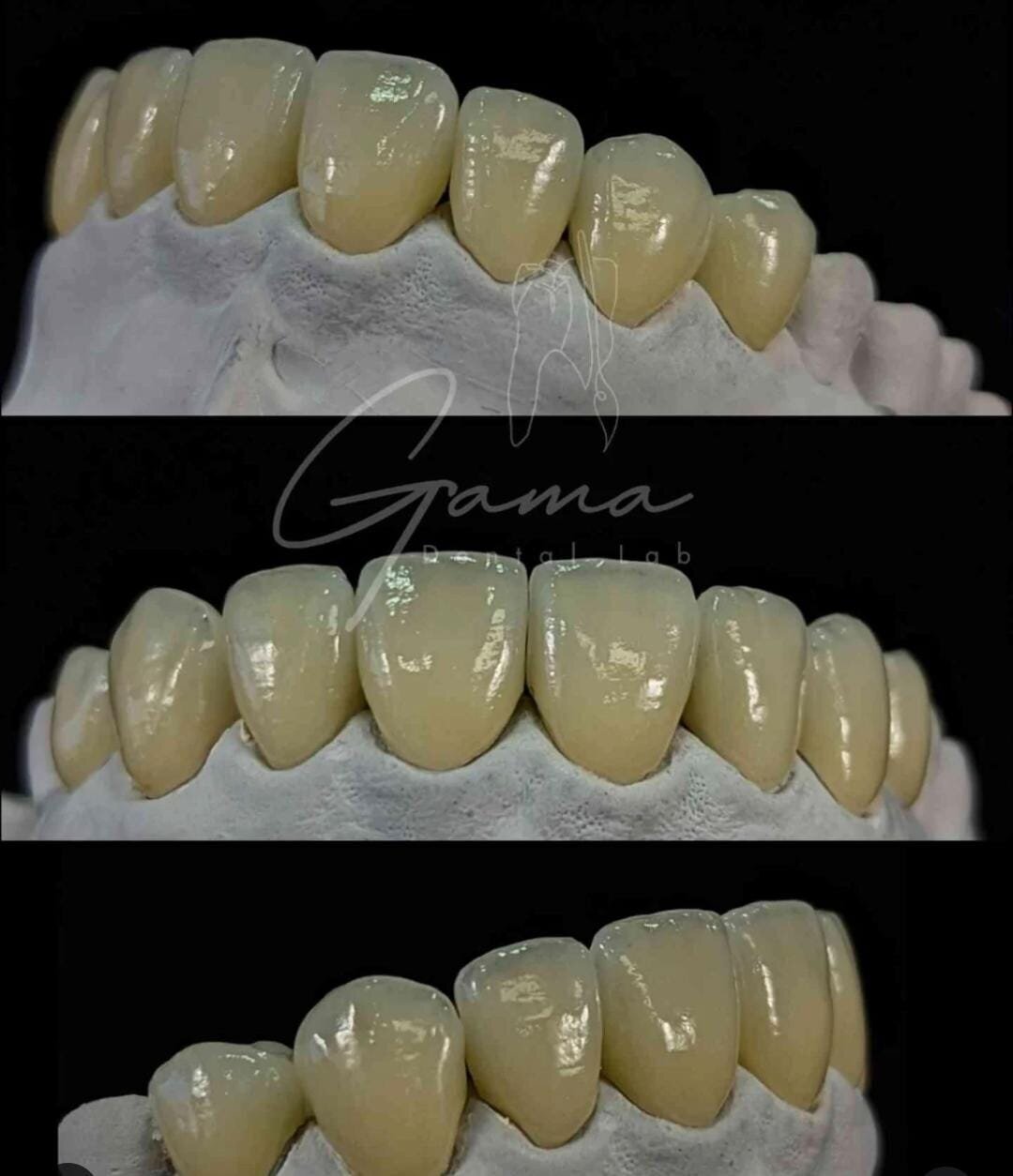 Carillas EMAX - Gama Dental Lab